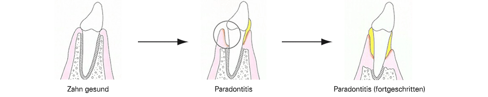 Paradontose Entwicklung